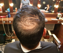 my hair transplant didn't work: what to do next